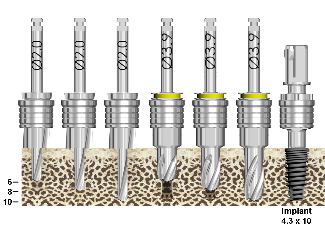 Fully Guided Keyless Kit » Shop Online » Blue Sky Bio Compatibility